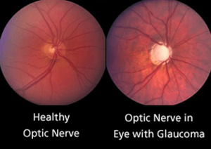 Glaucoma